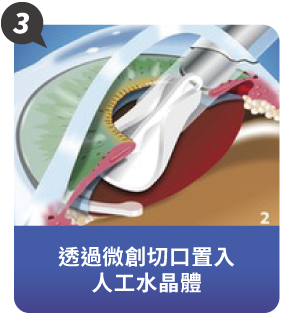什麼是LEX全視清老花雷射