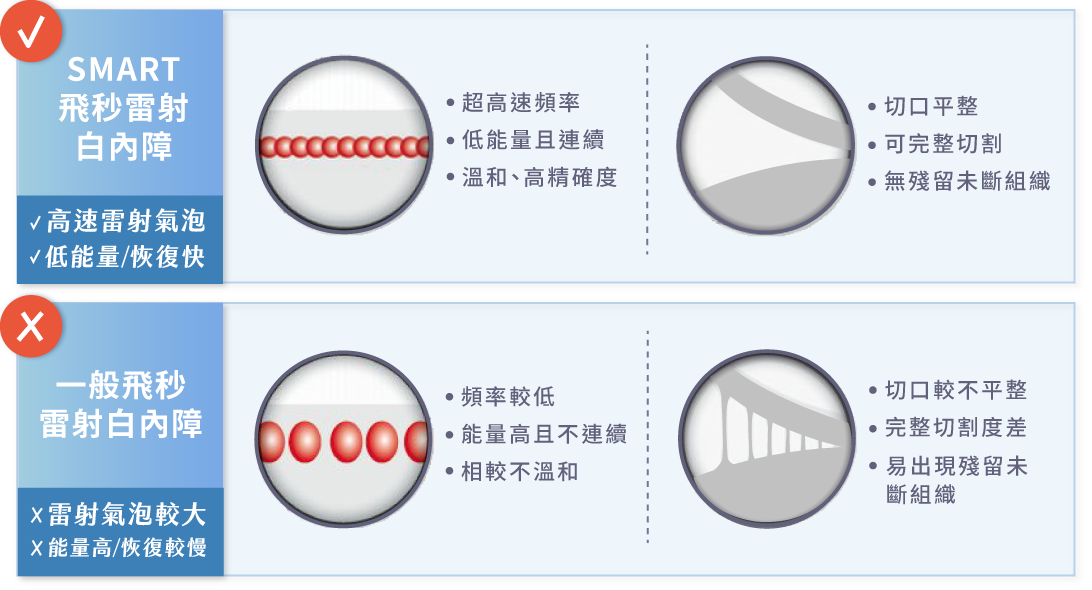 SMART飛秒雷射白內障優勢